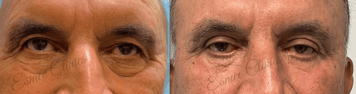 Before and After img